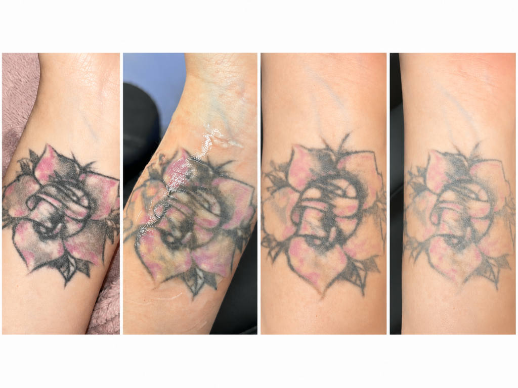 Four stages of laser tattoo removal showing gradual fading of black outlines and stubborn pink ink in a rose tattoo.