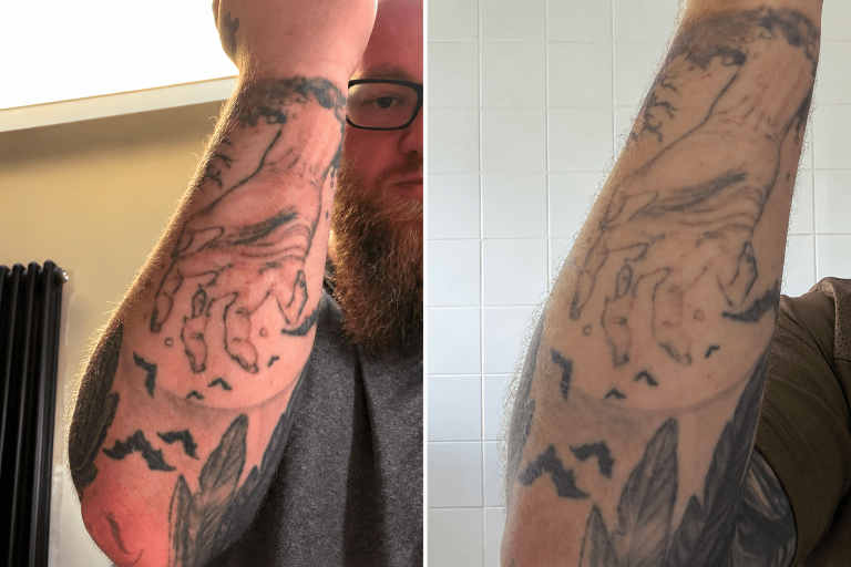 Side-by-side photographs showing fading of a black ink forearm tattoo following laser tattoo removal treatment in Croydon.
