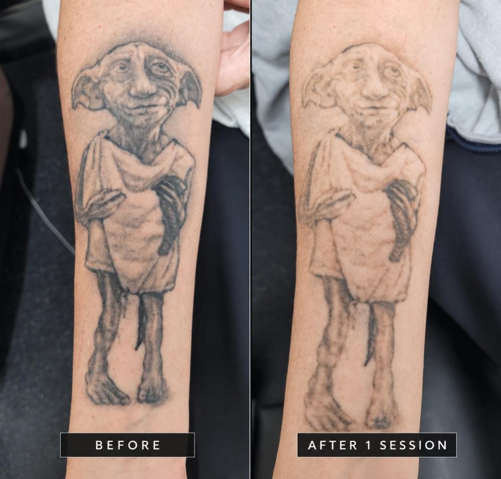 Before and after one laser tattoo removal session showing significant fading of a black ink Dobby tattoo in Croydon.