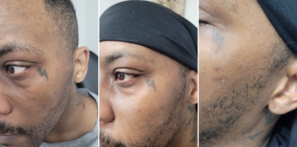 Three photographs showing the gradual fading of a small facial tattoo on dark skin following laser tattoo removal treatments.